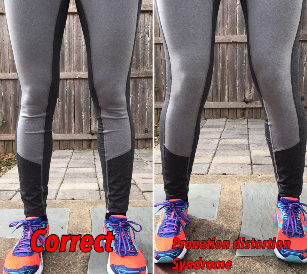 Side-by-side comparison of two pairs of legs in athletic wear: left legs stand straight labeled 'Correct,' right legs show inward ankle tilt labeled 'Pronation distortion syndrome.' Both wear colorful sneakers.